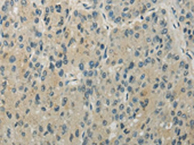 The image on the left is immunohistochemistry of paraffin-embedded Human liver cancer tissue using CSB-PA239457(RHOU Antibody) at dilution 1/30, on the right is treated with synthetic peptide. (Original magnification: ×200)