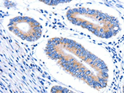 The image on the left is immunohistochemistry of paraffin-embedded Human colon cancer tissue using CSB-PA239614(HINT2 Antibody) at dilution 1/20, on the right is treated with synthetic peptide. (Original magnification: ×200)
