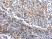 The image on the left is immunohistochemistry of paraffin-embedded Human tonsil tissue using CSB-PA239700(HDAC4 Antibody) at dilution 1/15, on the right is treated with synthetic peptide. (Original magnification: ×200)