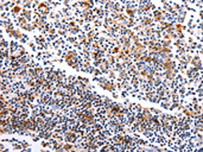 The image on the left is immunohistochemistry of paraffin-embedded Human tonsil tissue using CSB-PA239700(HDAC4 Antibody) at dilution 1/15, on the right is treated with synthetic peptide. (Original magnification: ×200)