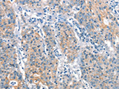 The image on the left is immunohistochemistry of paraffin-embedded Human gastic cancer tissue using CSB-PA239750(ARHGEF11 Antibody) at dilution 1/25, on the right is treated with synthetic peptide. (Original magnification: ×200)