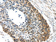 The image on the left is immunohistochemistry of paraffin-embedded Human esophagus cancer tissue using CSB-PA240091(GRIN2A Antibody) at dilution 1/30, on the right is treated with synthetic peptide. (Original magnification: ×200)