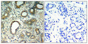 Immunohistochemical analysis of paraffin-embedded human breast carcinoma tissue using SHP-2(Phospho-Tyr580) Antibody(left) or the same antibody preincubated with blocking peptide(right).