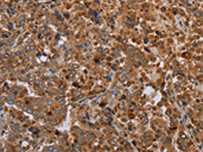 The image on the left is immunohistochemistry of paraffin-embedded Human liver cancer tissue using CSB-PA240355(REG3A Antibody) at dilution 1/20, on the right is treated with synthetic peptide. (Original magnification: ×200)