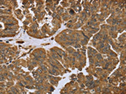 The image on the left is immunohistochemistry of paraffin-embedded Human ovarian cancer tissue using CSB-PA240464(IKBIP Antibody) at dilution 1/40, on the right is treated with fusion protein. (Original magnification: ×200)