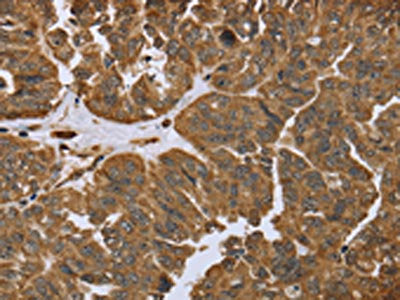The image on the left is immunohistochemistry of paraffin-embedded Human ovarian cancer tissue using CSB-PA240464(IKBIP Antibody) at dilution 1/40, on the right is treated with fusion protein. (Original magnification: ×200)