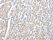 The image on the left is immunohistochemistry of paraffin-embedded Human breast cancer tissue using CSB-PA240615(ADA Antibody) at dilution 1/15, on the right is treated with fusion protein. (Original magnification: ×200)
