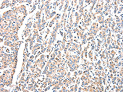 The image on the left is immunohistochemistry of paraffin-embedded Human breast cancer tissue using CSB-PA240615(ADA Antibody) at dilution 1/15, on the right is treated with fusion protein. (Original magnification: ×200)