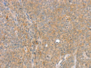 The image on the left is immunohistochemistry of paraffin-embedded Human ovarian cancer tissue using CSB-PA240703(SLC8A3 Antibody) at dilution 1/35, on the right is treated with synthetic peptide. (Original magnification: ×200)