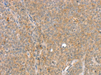 The image on the left is immunohistochemistry of paraffin-embedded Human ovarian cancer tissue using CSB-PA240703(SLC8A3 Antibody) at dilution 1/35, on the right is treated with synthetic peptide. (Original magnification: ×200)