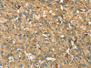 The image on the left is immunohistochemistry of paraffin-embedded Human liver cancer tissue using CSB-PA240849(HSD17B8 Antibody) at dilution 1/55, on the right is treated with fusion protein. (Original magnification: ×200)