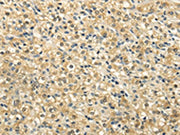 The image on the left is immunohistochemistry of paraffin-embedded Human prostate cancer tissue using CSB-PA240911(NSD1 Antibody) at dilution 1/25, on the right is treated with synthetic peptide. (Original magnification: ×200)The image on the left...