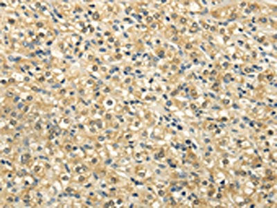 The image on the left is immunohistochemistry of paraffin-embedded Human prostate cancer tissue using CSB-PA240911(NSD1 Antibody) at dilution 1/25, on the right is treated with synthetic peptide. (Original magnification: ×200)The image on the left...