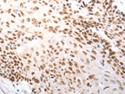 The image on the left is immunohistochemistry of paraffin-embedded Human cervical cancer tissue using CSB-PA240950(SLC22A8 Antibody) at dilution 1/25, on the right is treated with synthetic peptide. (Original magnification: ×200)