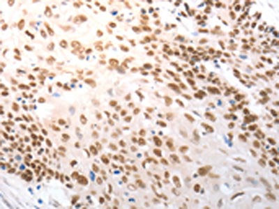 The image on the left is immunohistochemistry of paraffin-embedded Human cervical cancer tissue using CSB-PA240950(SLC22A8 Antibody) at dilution 1/25, on the right is treated with synthetic peptide. (Original magnification: ×200)