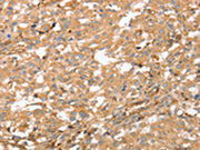 The image on the left is immunohistochemistry of paraffin-embedded Human thyroid cancer tissue using CSB-PA241286(AHSG Antibody) at dilution 1/60, on the right is treated with fusion protein. (Original magnification: ×200)