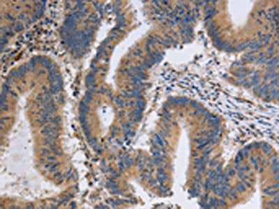 The image on the left is immunohistochemistry of paraffin-embedded Human colon cancer tissue using CSB-PA241349(ITPR1 Antibody) at dilution 1/40, on the right is treated with synthetic peptide. (Original magnification: ×200)