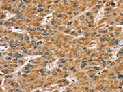 The image on the left is immunohistochemistry of paraffin-embedded Human liver cancer tissue using CSB-PA241538(SDCBP Antibody) at dilution 1/45, on the right is treated with fusion protein. (Original magnification: ×200)