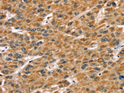 The image on the left is immunohistochemistry of paraffin-embedded Human liver cancer tissue using CSB-PA241538(SDCBP Antibody) at dilution 1/45, on the right is treated with fusion protein. (Original magnification: ×200)
