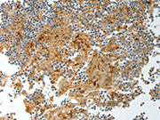 The image on the left is immunohistochemistry of paraffin-embedded Human tonsil tissue using CSB-PA241683(PRCP Antibody) at dilution 1/20, on the right is treated with fusion protein. (Original magnification: ×200)