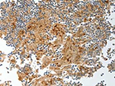 The image on the left is immunohistochemistry of paraffin-embedded Human tonsil tissue using CSB-PA241683(PRCP Antibody) at dilution 1/20, on the right is treated with fusion protein. (Original magnification: ×200)