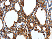 The image on the left is immunohistochemistry of paraffin-embedded Human thyroid cancer tissue using CSB-PA241726(MTNR1A Antibody) at dilution 1/40, on the right is treated with synthetic peptide. (Original magnification: ×200)