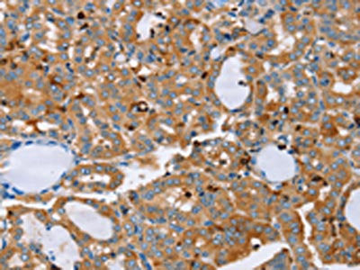 The image on the left is immunohistochemistry of paraffin-embedded Human thyroid cancer tissue using CSB-PA241730(PLS3 Antibody) at dilution 1/20, on the right is treated with fusion protein. (Original magnification: ×200)