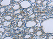 The image on the left is immunohistochemistry of paraffin-embedded Human thyroid cancer tissue using CSB-PA241758(EGFL7 Antibody) at dilution 1/20, on the right is treated with fusion protein. (Original magnification: ×200)