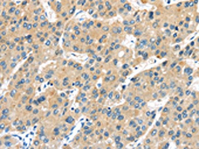 The image on the left is immunohistochemistry of paraffin-embedded Human liver cancer tissue using CSB-PA241790(UBL3 Antibody) at dilution 1/30, on the right is treated with fusion protein. (Original magnification: ×200)