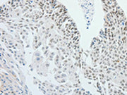The image on the left is immunohistochemistry of paraffin-embedded Human cervical cancer tissue using CSB-PA241902(RPS6KB1 Antibody) at dilution 1/25, on the right is treated with fusion protein. (Original magnification: ×200)