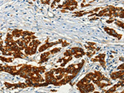 The image on the left is immunohistochemistry of paraffin-embedded Human colon cancer tissue using CSB-PA241921(ADCY3 Antibody) at dilution 1/50, on the right is treated with fusion protein. (Original magnification: ×200)