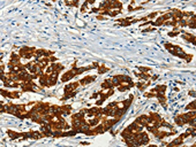 The image on the left is immunohistochemistry of paraffin-embedded Human colon cancer tissue using CSB-PA241921(ADCY3 Antibody) at dilution 1/50, on the right is treated with fusion protein. (Original magnification: ×200)