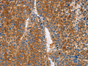 The image on the left is immunohistochemistry of paraffin-embedded Human liver cancer tissue using CSB-PA242213(LTF Antibody) at dilution 1/50, on the right is treated with fusion protein. (Original magnification: ×200)