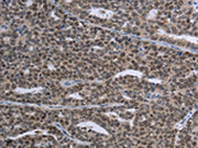 The image on the left is immunohistochemistry of paraffin-embedded Human ovarian cancer tissue using CSB-PA242233(MAGEC1 Antibody) at dilution 1/30, on the right is treated with synthetic peptide. (Original magnification: ×200)