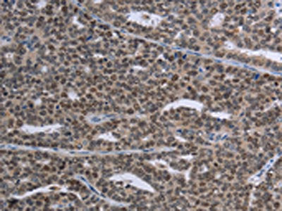 The image on the left is immunohistochemistry of paraffin-embedded Human ovarian cancer tissue using CSB-PA242233(MAGEC1 Antibody) at dilution 1/30, on the right is treated with synthetic peptide. (Original magnification: ×200)
