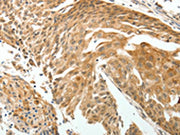 The image on the left is immunohistochemistry of paraffin-embedded Human cervical cancer tissue using CSB-PA242246(ROCK2 Antibody) at dilution 1/15, on the right is treated with fusion protein. (Original magnification: ×200)