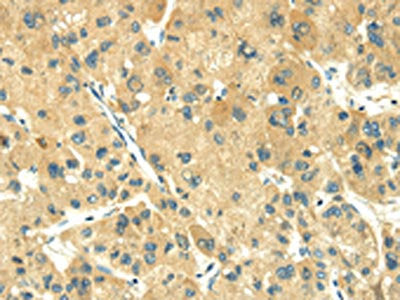 The image on the left is immunohistochemistry of paraffin-embedded Human liver cancer tissue using CSB-PA242603(TRIM10 Antibody) at dilution 1/35, on the right is treated with fusion protein. (Original magnification: ×200)