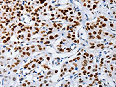 The image on the left is immunohistochemistry of paraffin-embedded Human lung cancer tissue using CSB-PA242639(MUTYH Antibody) at dilution 1/60, on the right is treated with fusion protein. (Original magnification: ×200)