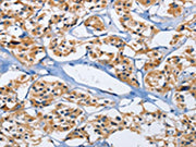 The image on the left is immunohistochemistry of paraffin-embedded Human thyroid cancer tissue using CSB-PA242652(DUSP19 Antibody) at dilution 1/30, on the right is treated with fusion protein. (Original magnification: ×200)