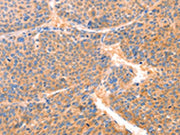 The image on the left is immunohistochemistry of paraffin-embedded Human liver cancer tissue using CSB-PA242653(PRDX2 Antibody) at dilution 1/80, on the right is treated with synthetic peptide. (Original magnification: ×200)