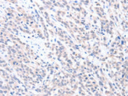 The image on the left is immunohistochemistry of paraffin-embedded Human esophagus cancer tissue using CSB-PA242662(ABLIM1 Antibody) at dilution 1/25, on the right is treated with fusion protein. (Original magnification: ×200)