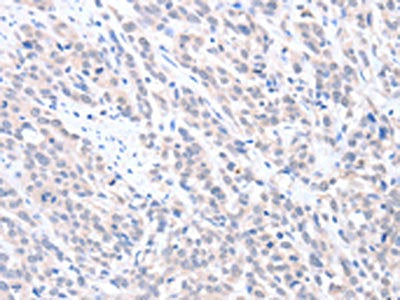 The image on the left is immunohistochemistry of paraffin-embedded Human esophagus cancer tissue using CSB-PA242662(ABLIM1 Antibody) at dilution 1/25, on the right is treated with fusion protein. (Original magnification: ×200)