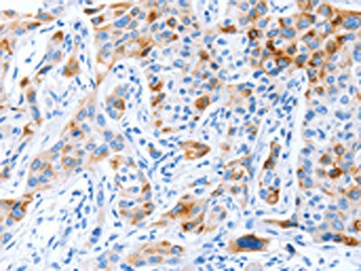 The image on the left is immunohistochemistry of paraffin-embedded Human lung cancer tissue using CSB-PA242765(PROM1 Antibody) at dilution 1/70, on the right is treated with synthetic peptide. (Original magnification: ×200)