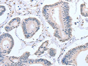 The image on the left is immunohistochemistry of paraffin-embedded Human colon cancer tissue using CSB-PA242845(APEX1 Antibody) at dilution 1/20, on the right is treated with fusion protein. (Original magnification: ×200)