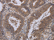 The image on the left is immunohistochemistry of paraffin-embedded Human colon cancer tissue using CSB-PA242915(LEPREL2 Antibody) at dilution 1/40, on the right is treated with fusion protein. (Original magnification: ×200)