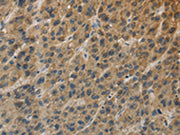 The image on the left is immunohistochemistry of paraffin-embedded Human liver cancer tissue using CSB-PA243064(TBXAS1 Antibody) at dilution 1/25, on the right is treated with fusion protein. (Original magnification: ×200)