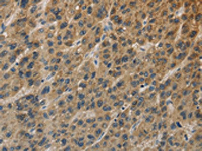 The image on the left is immunohistochemistry of paraffin-embedded Human liver cancer tissue using CSB-PA243064(TBXAS1 Antibody) at dilution 1/25, on the right is treated with fusion protein. (Original magnification: ×200)