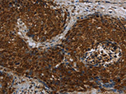 The image on the left is immunohistochemistry of paraffin-embedded Human cervical cancer tissue using CSB-PA243120(CERS5 Antibody) at dilution 1/40, on the right is treated with synthetic peptide. (Original magnification: ×200)