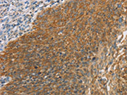 The image on the left is immunohistochemistry of paraffin-embedded Human cervical cancer tissue using CSB-PA243230(MAPK6 Antibody) at dilution 1/40, on the right is treated with synthetic peptide. (Original magnification: ×200)