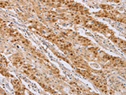The image on the left is immunohistochemistry of paraffin-embedded Human gastic cancer tissue using CSB-PA243587(MCM5 Antibody) at dilution 1/40, on the right is treated with fusion protein. (Original magnification: ×200)